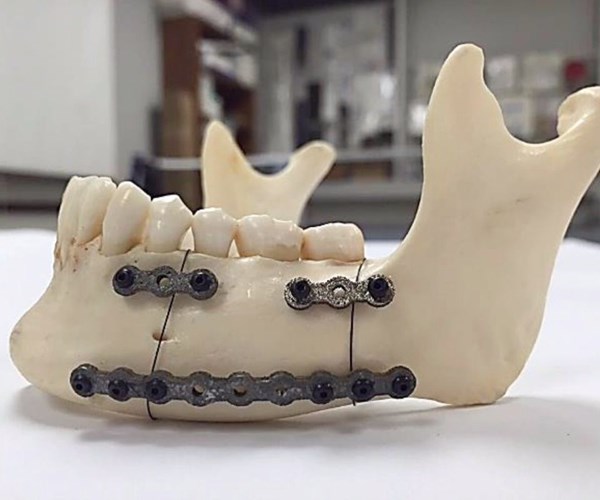 Jaw Fracture Surgery